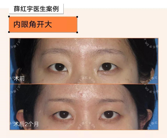 内眦赘皮又称"蒙古皱襞",表现为内眼角处有纵向的皮_圈子-新氧美容