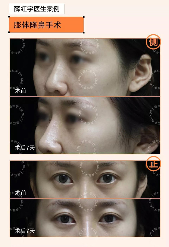 内眦赘皮又称"蒙古皱襞",表现为内眼角处有纵向的皮_圈子-新氧美容