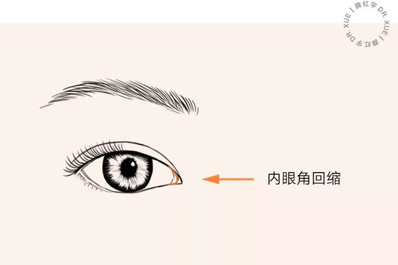 内眦赘皮又称蒙古皱襞,表现为内眼角处有纵向的皮
