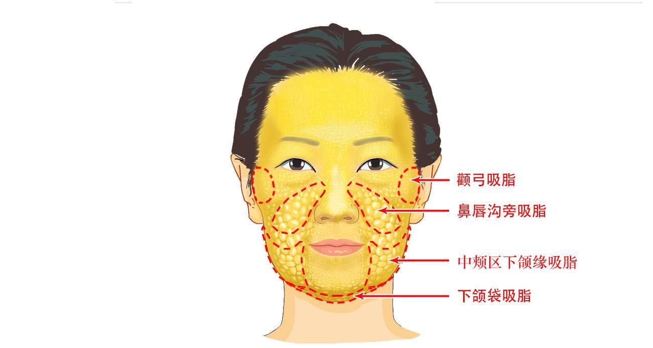 面部吸脂一般多少錢