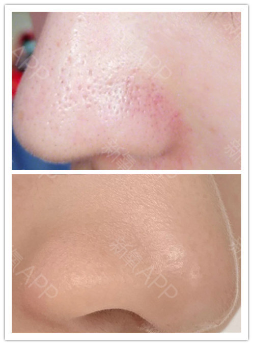 点阵激光去黑头效果好,当然可能其中有一部分人是通过三次才祛除黑头