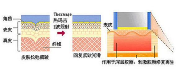 超声提升和热玛吉该怎么选 新氧美容整形