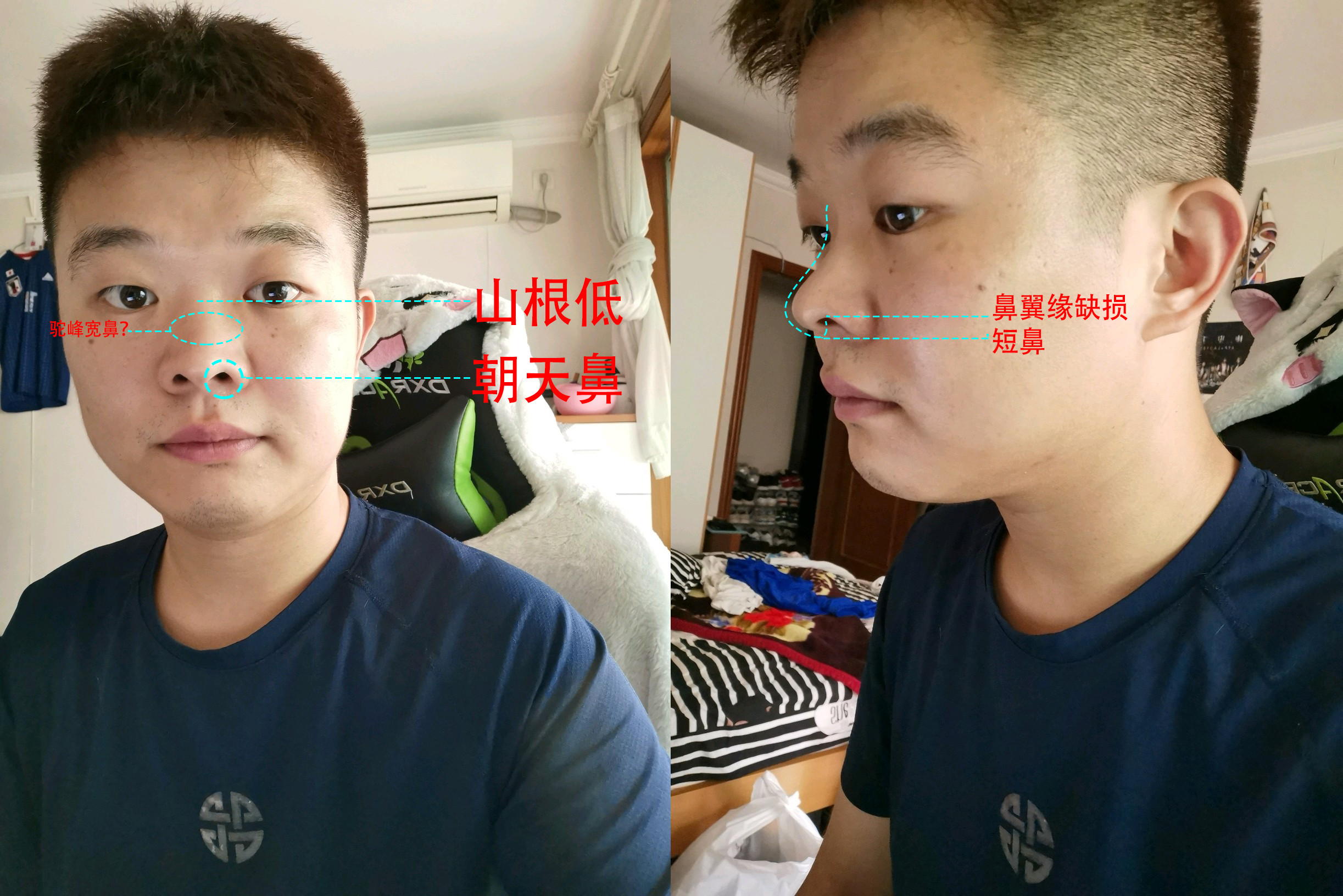 男生这样的鼻子 如何整形 新氧美容整形