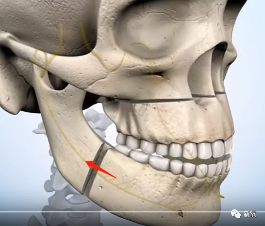 第二步在下巴骨上截开一小节骨头前移,形成一个比例适中,前翘的下巴