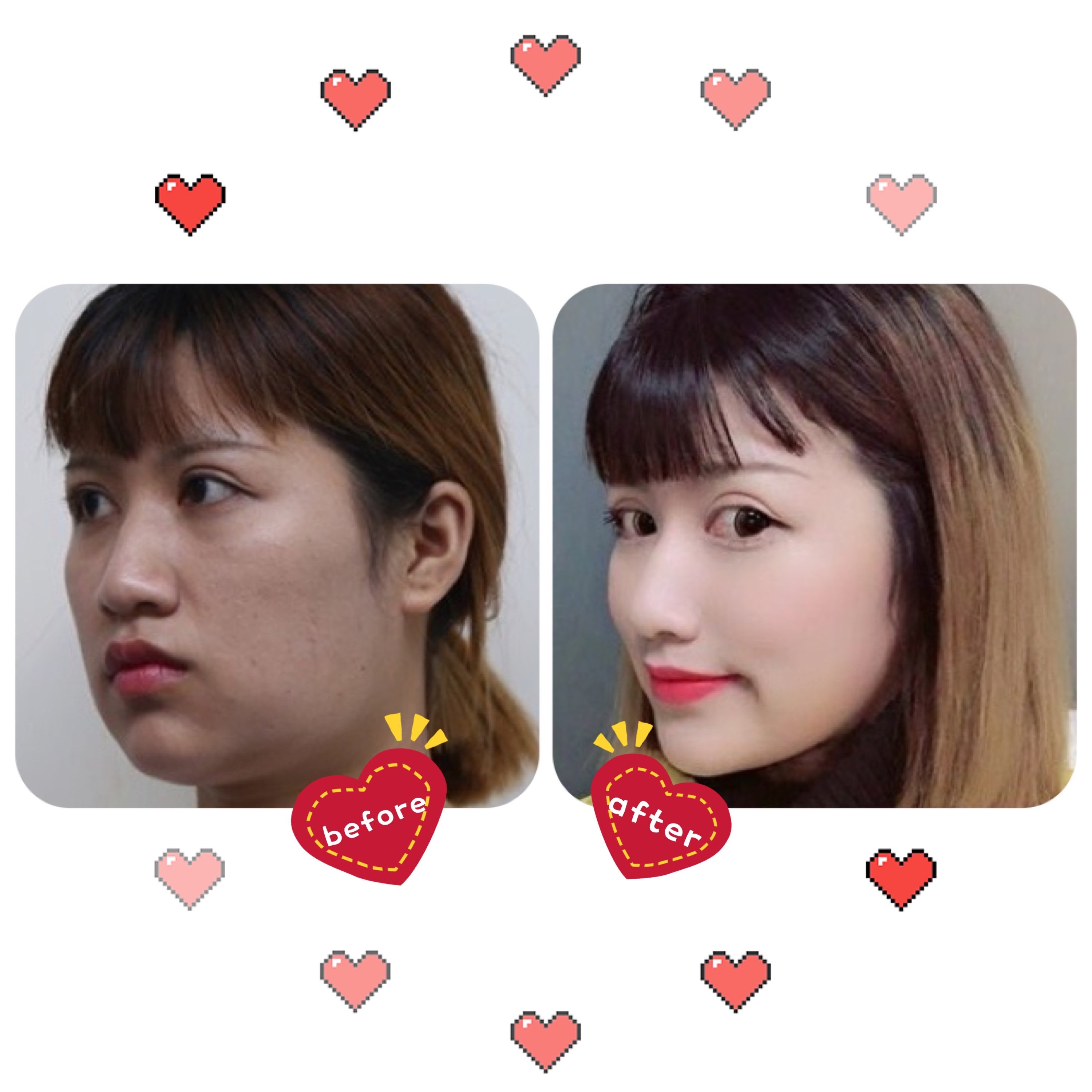 在上海做的磨骨(下颌角)4个月左右的记录