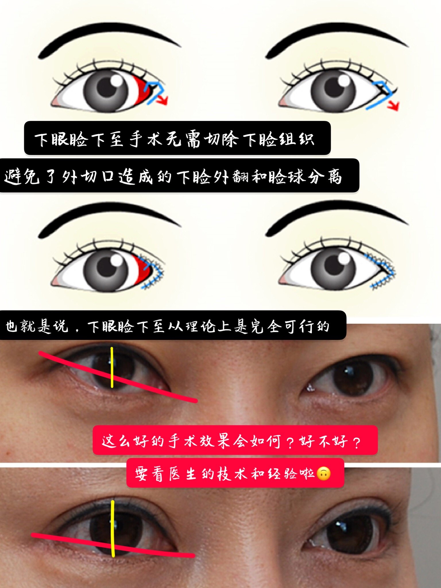 不到万不得已尽量不要开外眼角