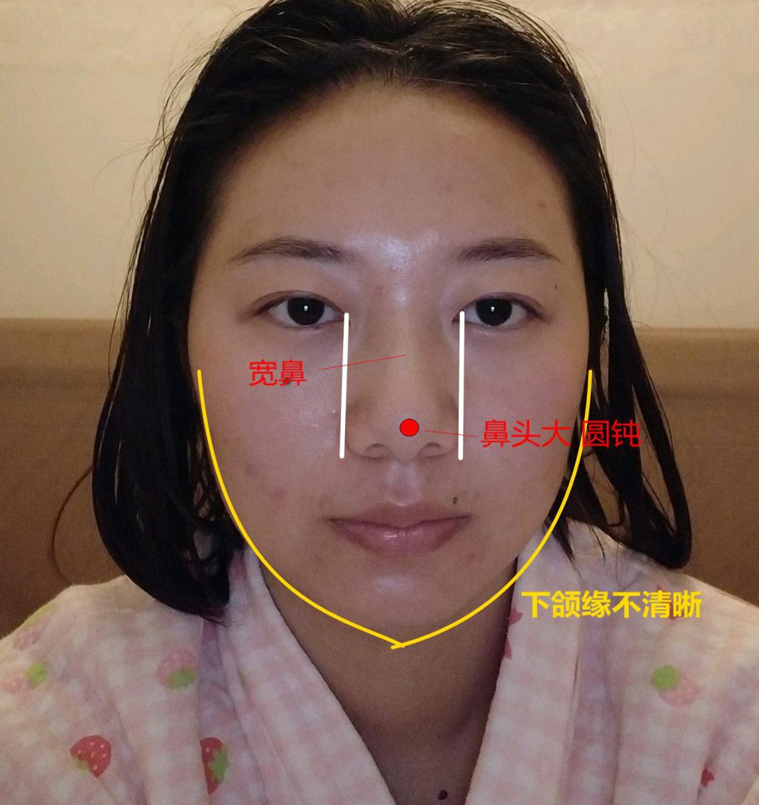 ①下颌缘不清晰,建议减肥 吸脂;②鼻头大宽鼻,鼻尖表现点不够,山根低
