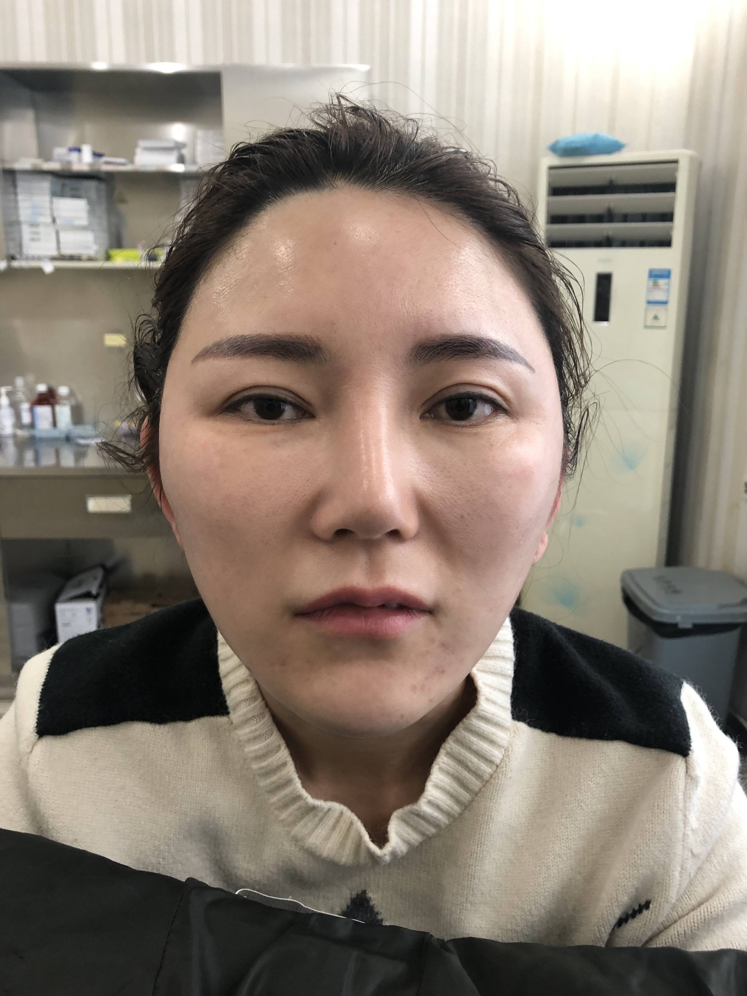 线雕提升术后出现红肿这是正常的吗?