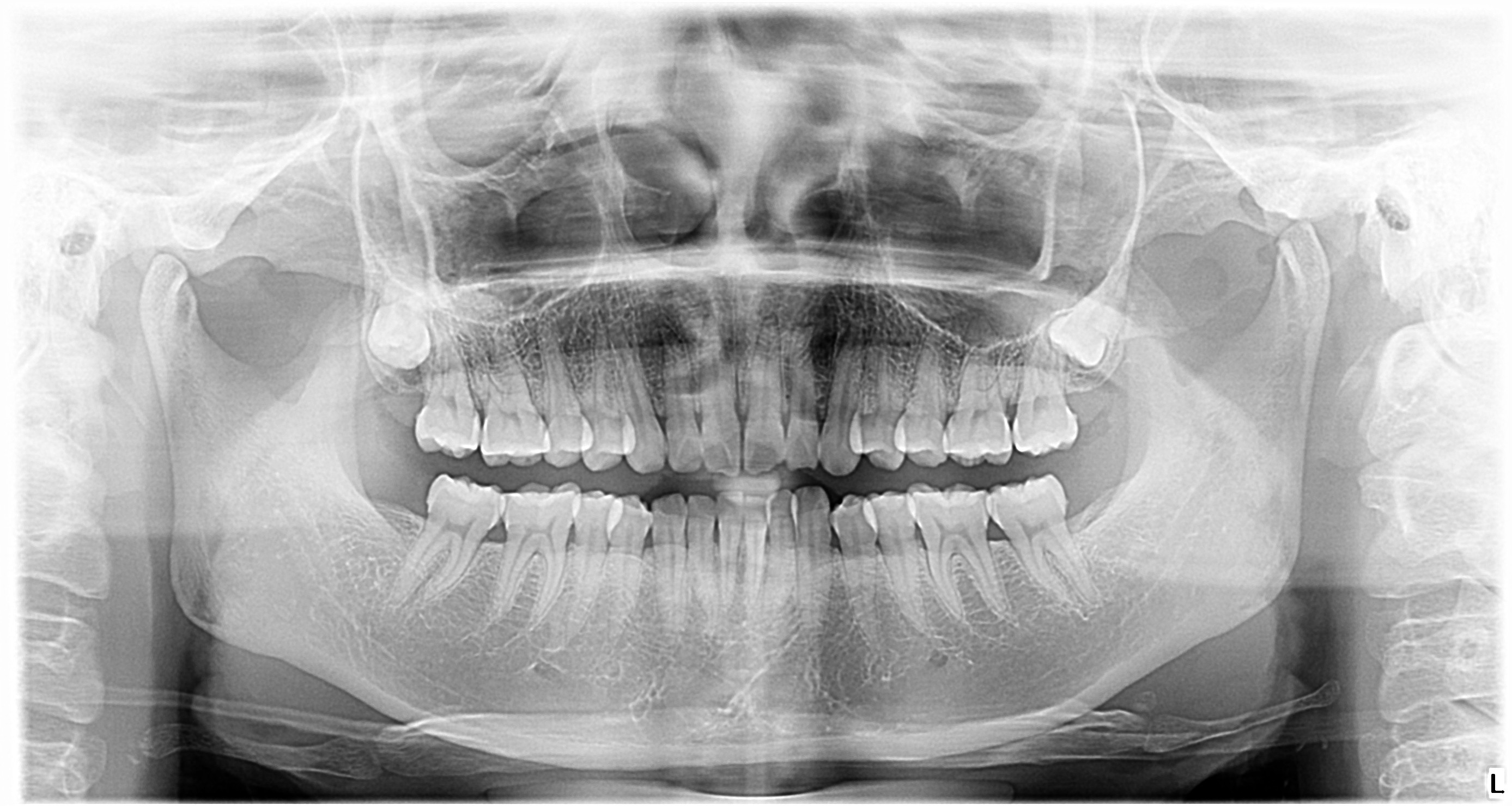 跟题主一样,下颌角很方,还凸嘴 牙齿不整齐,我也想弄一下颌面了.
