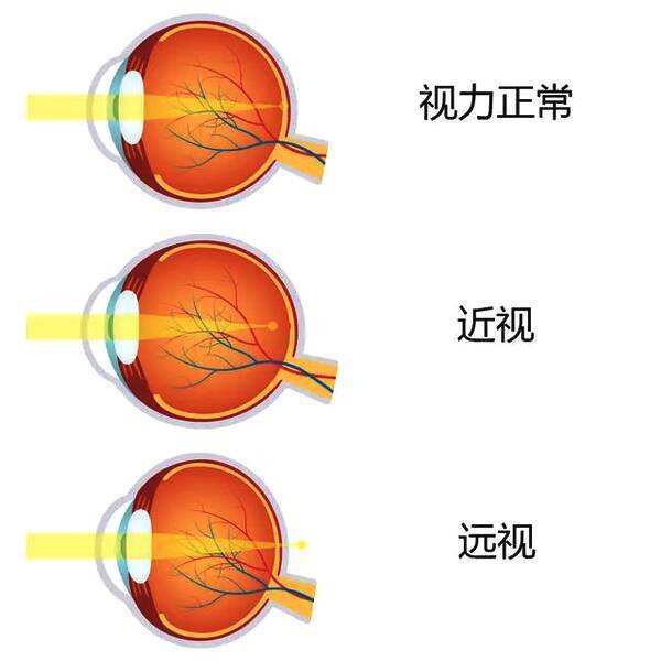 近视眼球突出怎么恢复图片