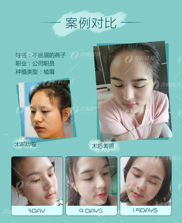 纹眉好还是种植眉毛好 新氧美容整形