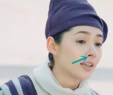 "倒八字"外露鼻孔,颜值大黑洞还有救吗?