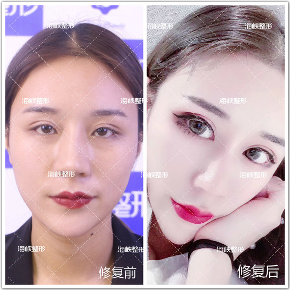 双眼皮的宽度要根据一个人的脸型,眉弓至睑缘的宽窄(即上眼皮的宽窄)