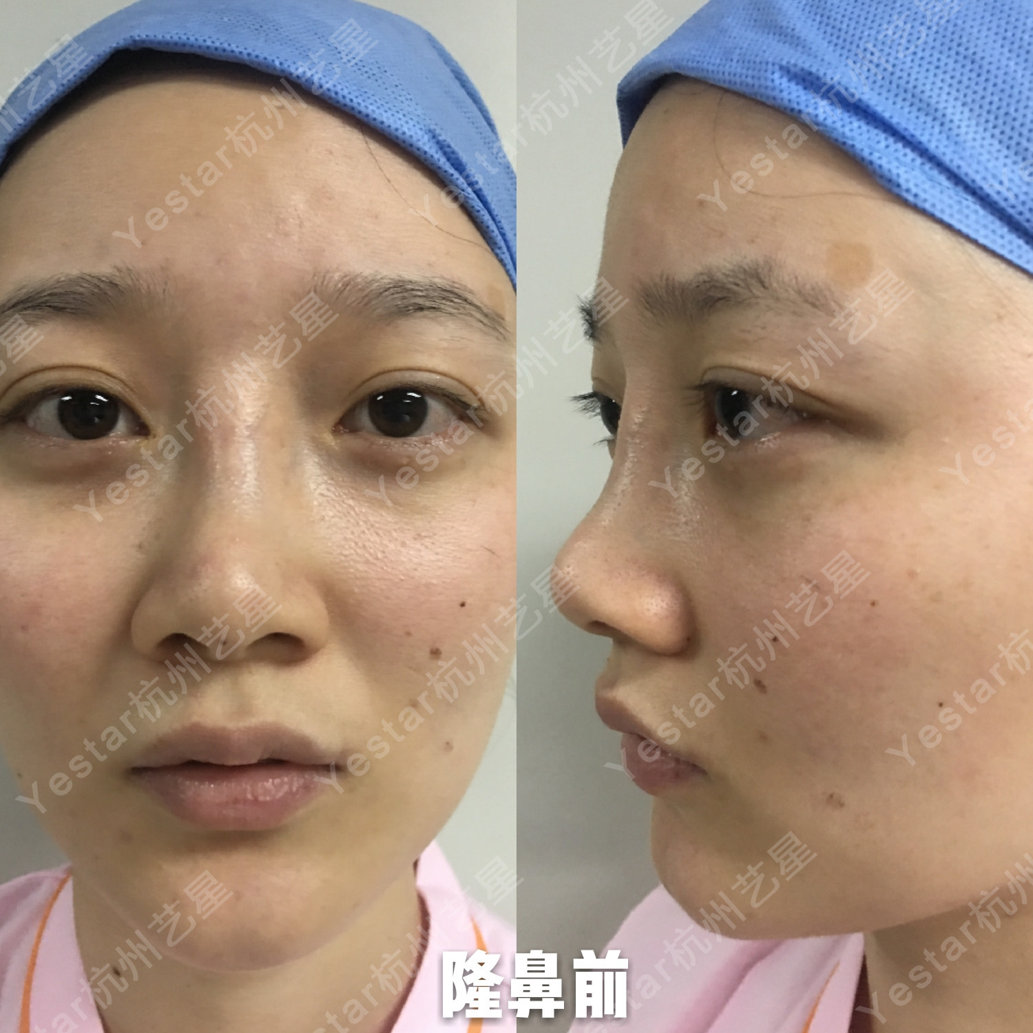 隆鼻耳软骨隆鼻_隆鼻耳软骨会被吸收吗_隆鼻耳软骨放哪个位置