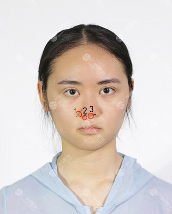 自己鼻基底凹陷法令纹严重侧面看着鼻子特别短不知道是嘴凸还是鼻基底