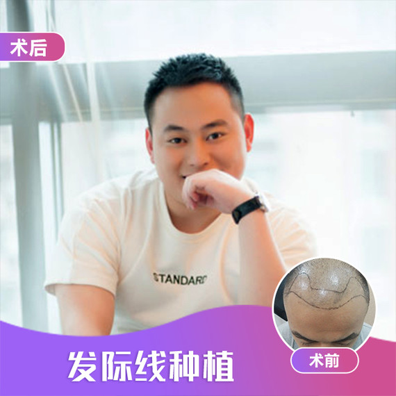 所以说,种植的头发毫无疑问是非常自然的.