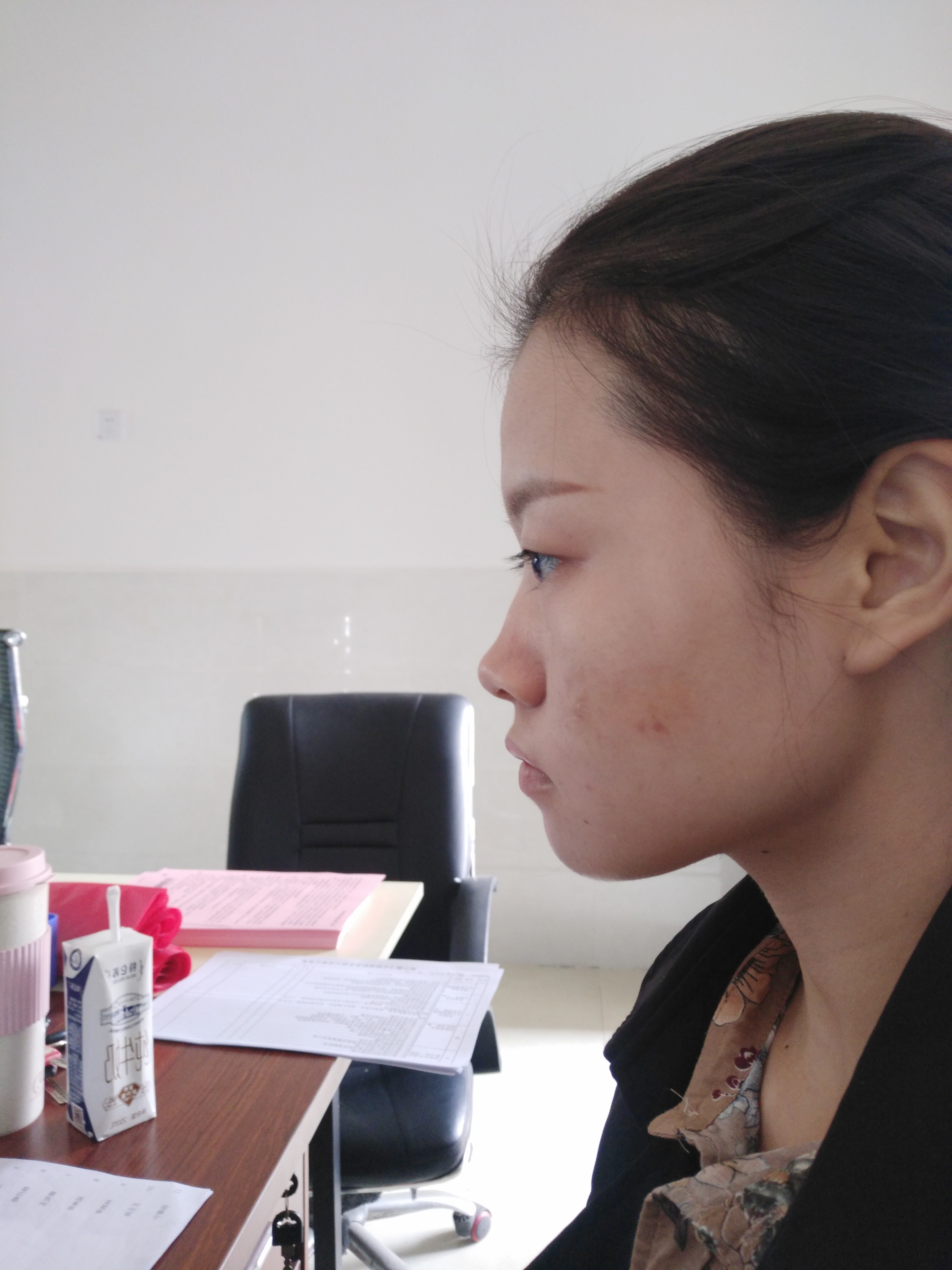 总感觉自己面中发育不全,我这是不是鼻基底凹陷啊?