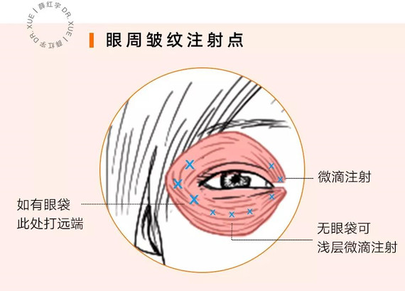 (具体注射位置,剂量根据实际情况适当调整)       【医生需