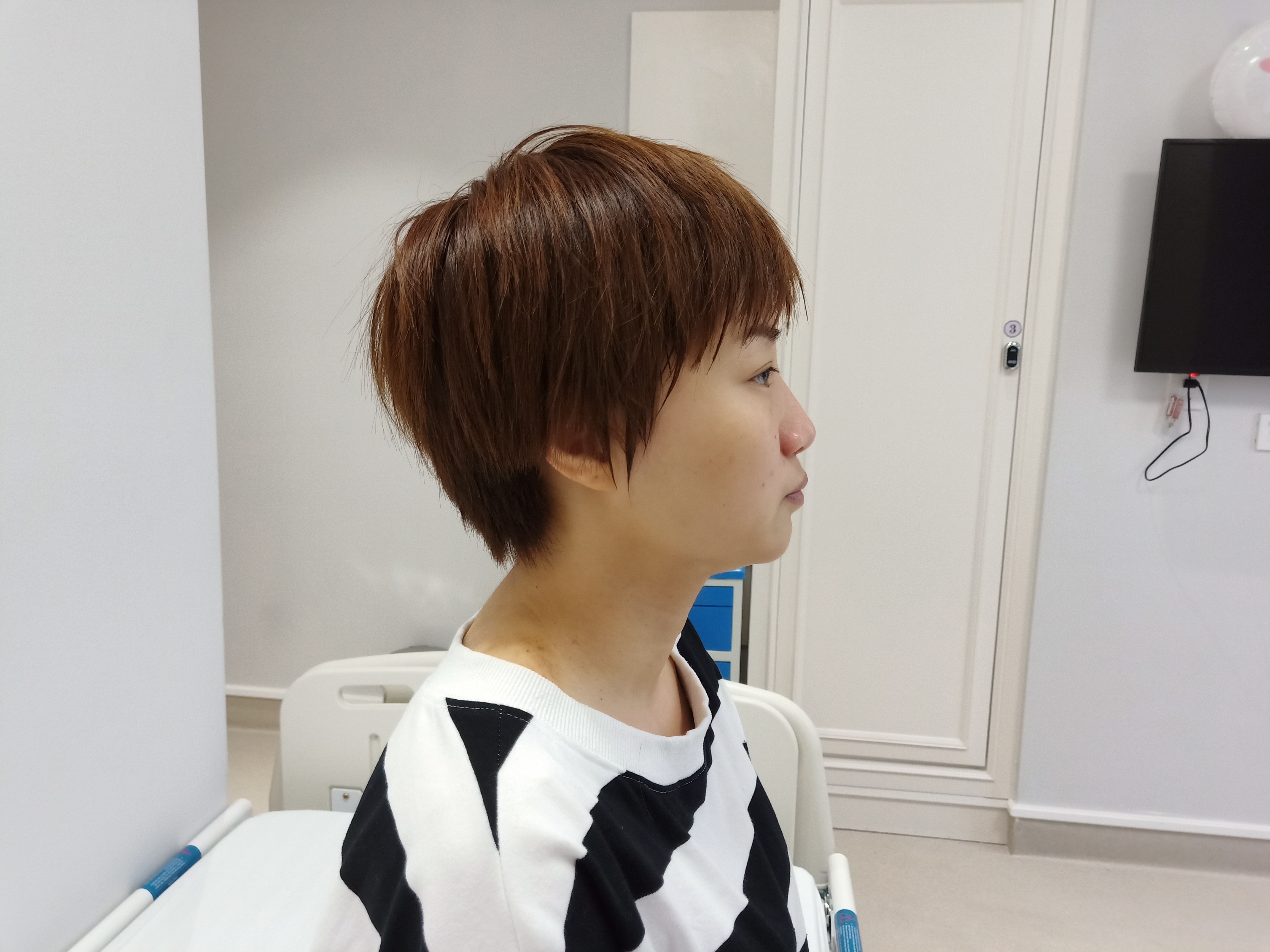 有鼻翼宽大的问题,可以只缩窄鼻翼吗?