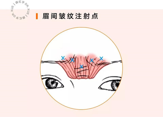 如图所示,△当皱眉肌,降眉间肌,降眉肌收缩时,▽就会出现眉间皱纹