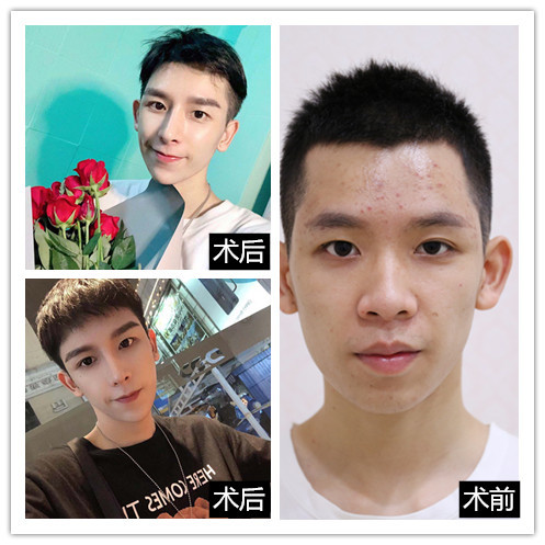 鼻骨内推鼻翼缩小鼻头缩小半肋21天了!