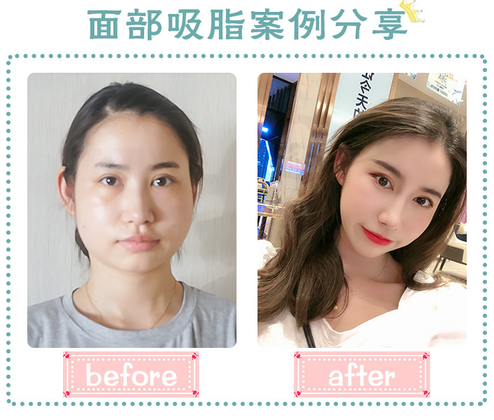 面部吸脂和溶脂针那个效果好 新氧 专业医美服务平台