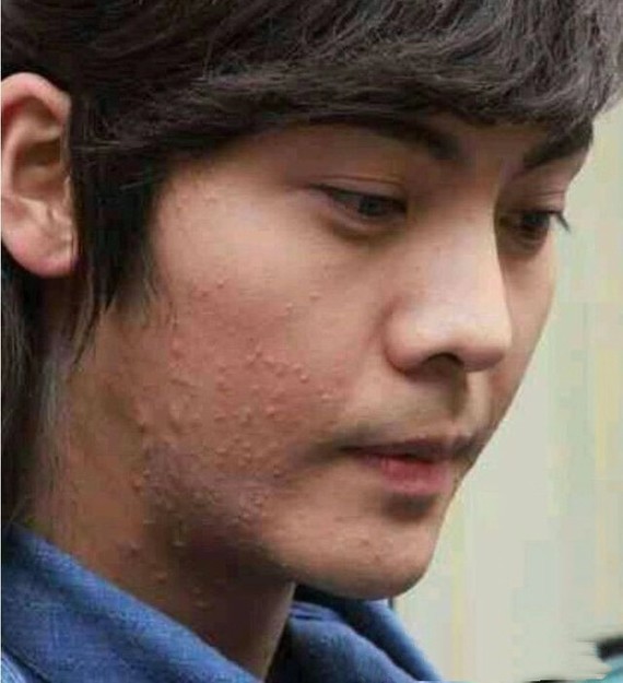 榜首:陈伟霆张艺兴脸上的痘痘时间算是不短了,在录制《极限应战》时