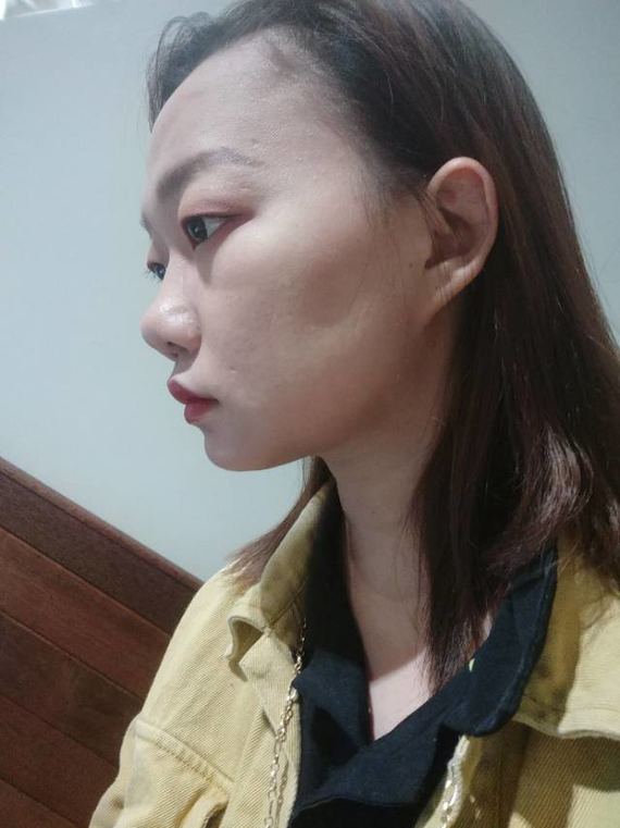 我是肿泡眼单眼皮加近视戴眼镜带的眼球突出了,脸上肉特别多没有下颚