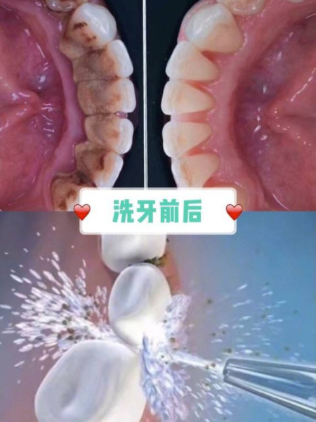 洗牙好不好 好 洗牙对牙齿保健意义重大 能有效清除 圈子 新氧美容整形