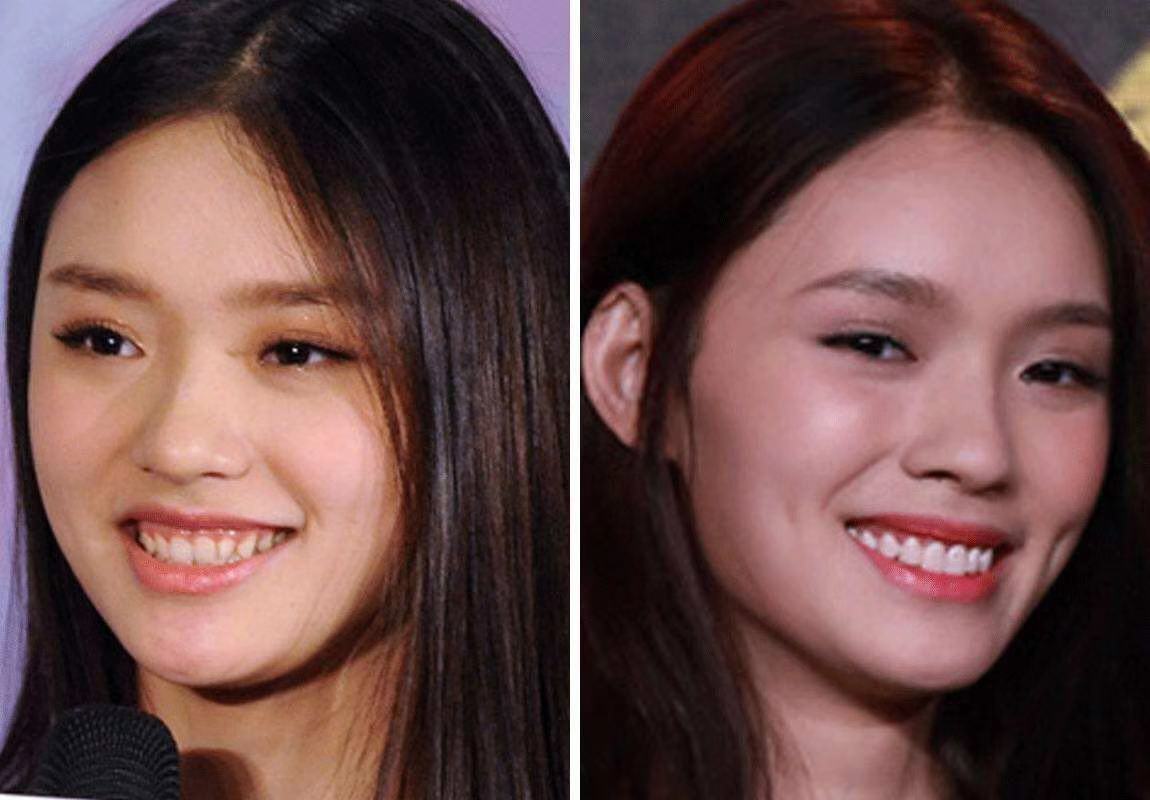 为啥现在的小孩都很少有颌面问题了,我们小时候好多朋友都是龅牙啊?