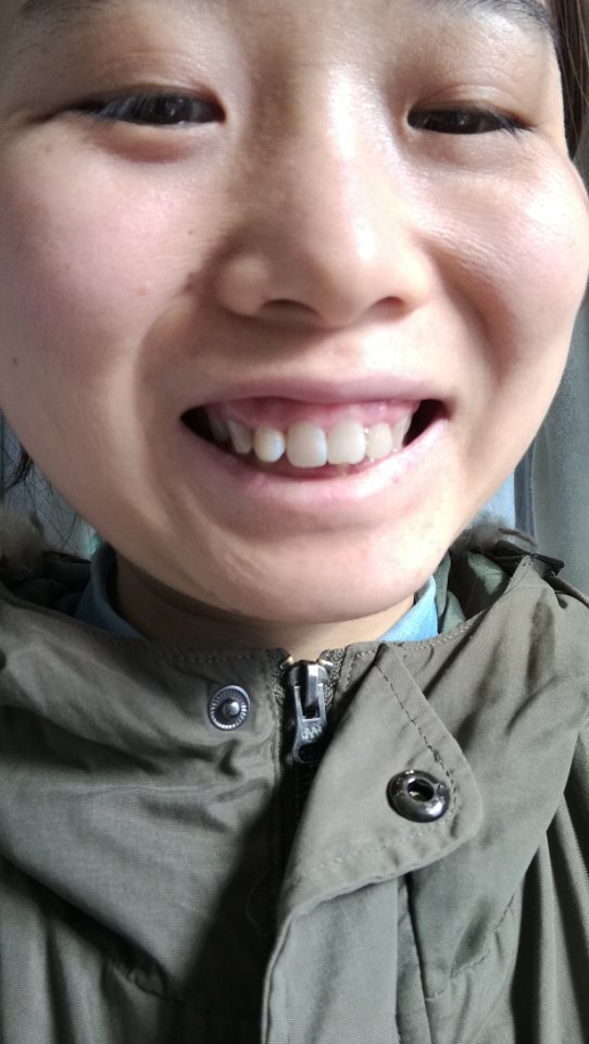 一笑就露牙龈_圈子-新氧美容整形