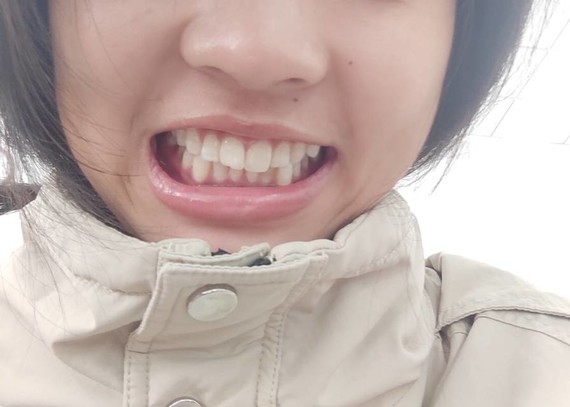 我这算是下面长了颗虎牙吗