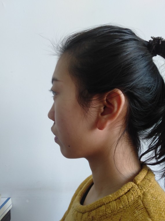 家族遗传的骨性凸嘴,笑的时候不会特别明显,没表情的时候嘴巴都闭不上