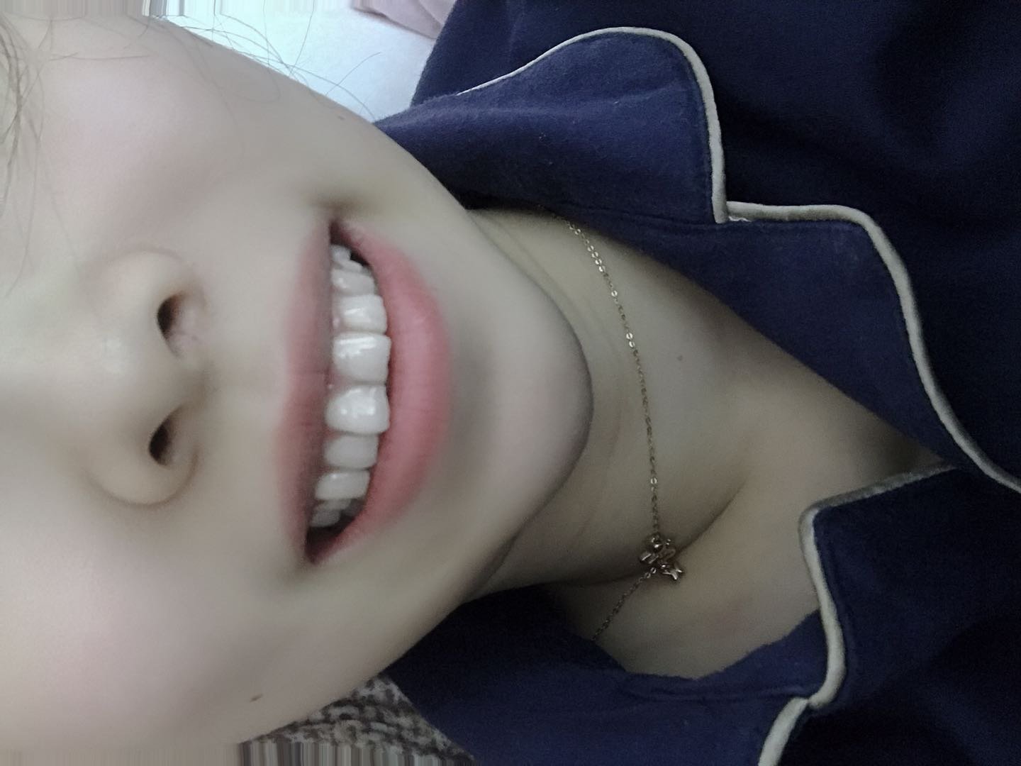 歪了一颗牙整个嘴都不好看了,尤其是我一笑就露牙龈,惨不忍睹