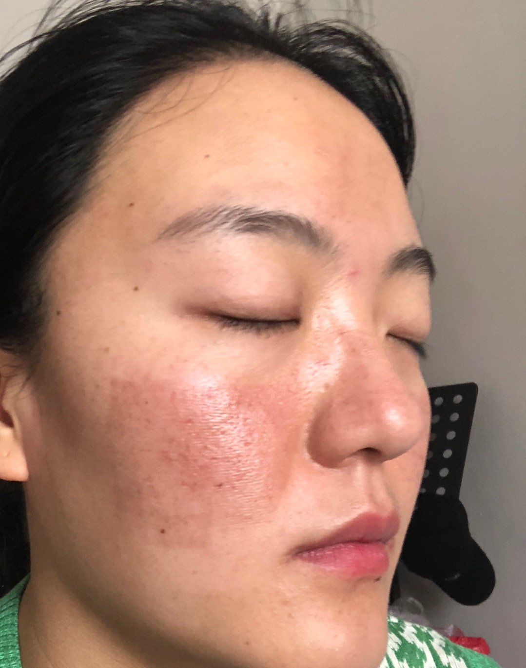 上个月做了点阵激光去痘坑可是做完后皮肤出现色沉脸上网格状的印子