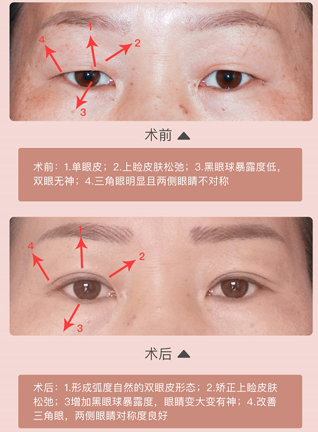 想听听大家的意见 我该 双眼皮吗 新氧美容整形