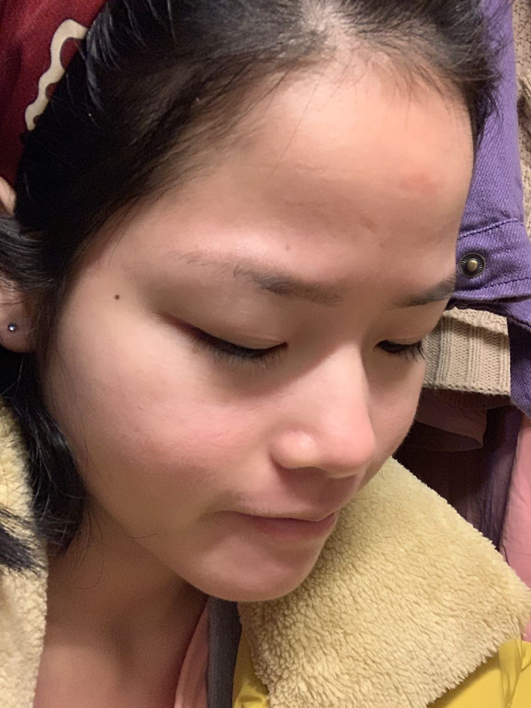 第一次投稿!脸歪,额头太高还凹陷,有_新氧-专业医美服务平台