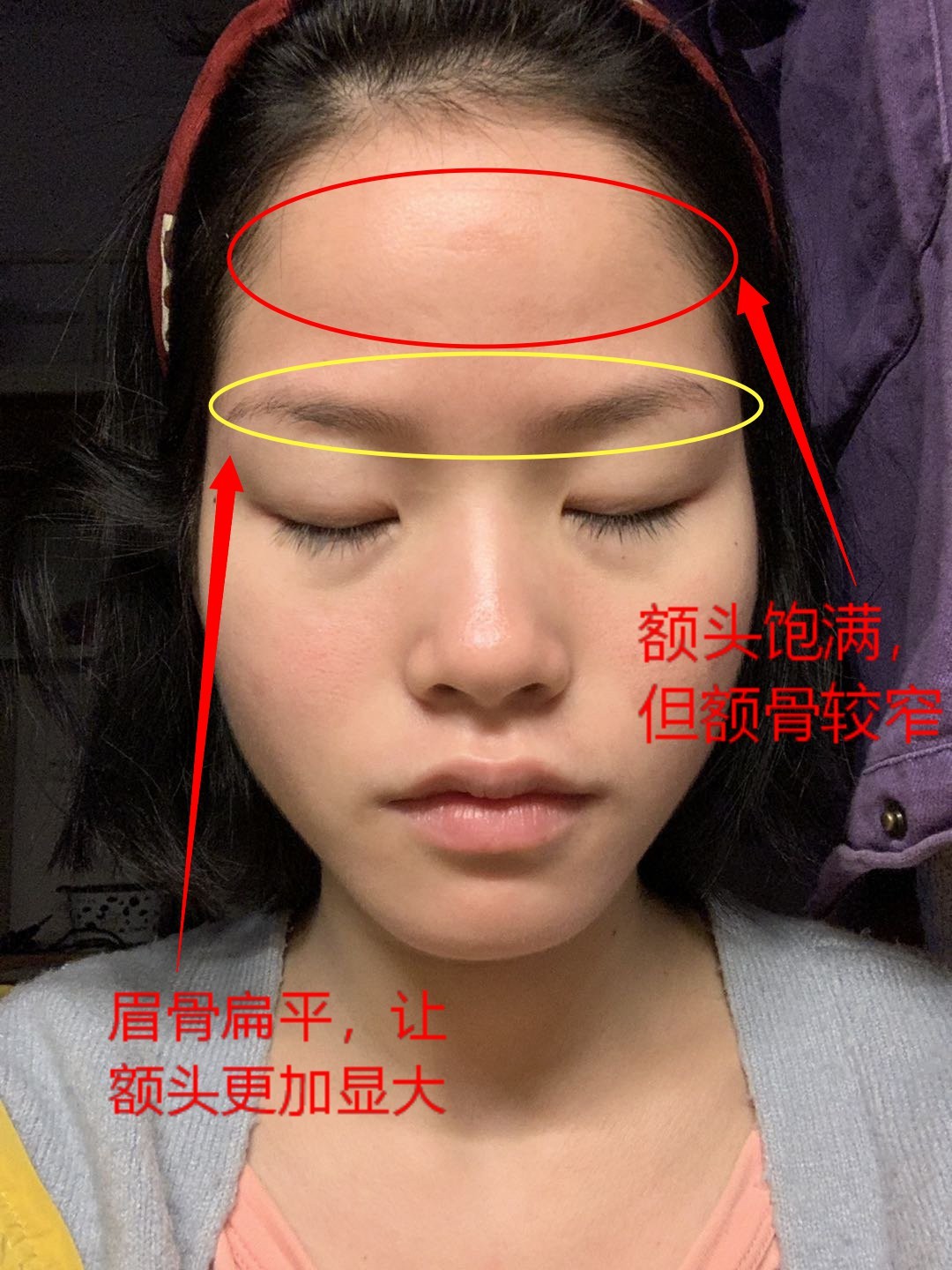 第一次投稿 脸歪 额头太高还凹陷 有 新氧美容整形
