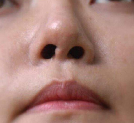 为什么隆鼻后鼻孔会不对称呢?还能不能隆鼻了?
