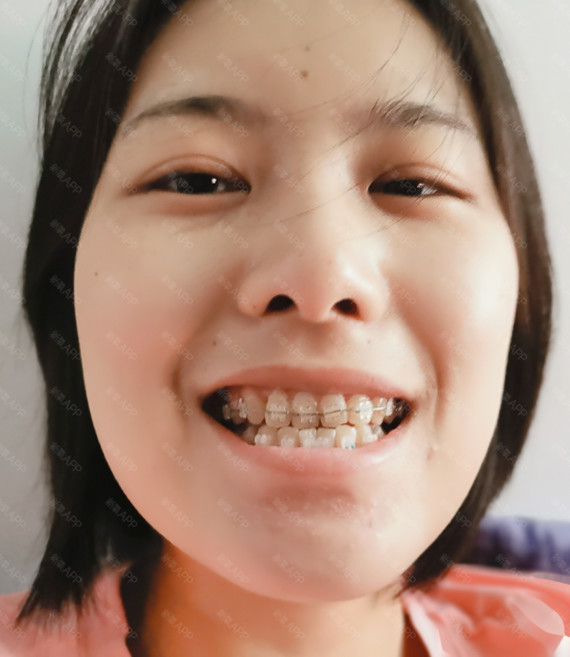 我的正畸之路:先自爆情况是:上下门牙,里凹,咬合不_圈子-新氧美容整形