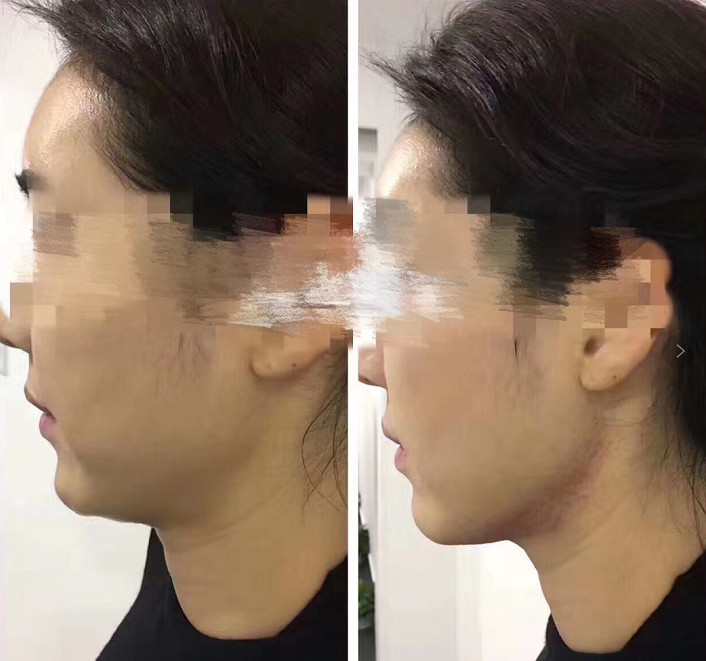 颊部的一块脂肪型凸起,大多数的婴儿肥就是因为颊脂垫的肥大的原因