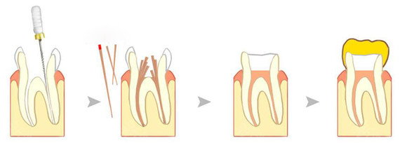 根管治疗之所以如此的贵,就是因为它本身具有一定的