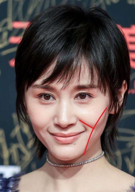 王子文同款填充[:66]轻盈饱满少女感[:66]新_圈子-新氧美容整形
