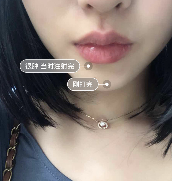 玻尿酸丰唇珠