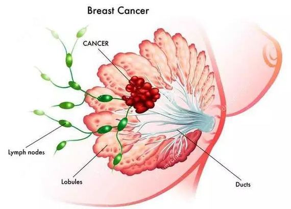 切除乳房还能做性感妹子乳腺癌怎么保住