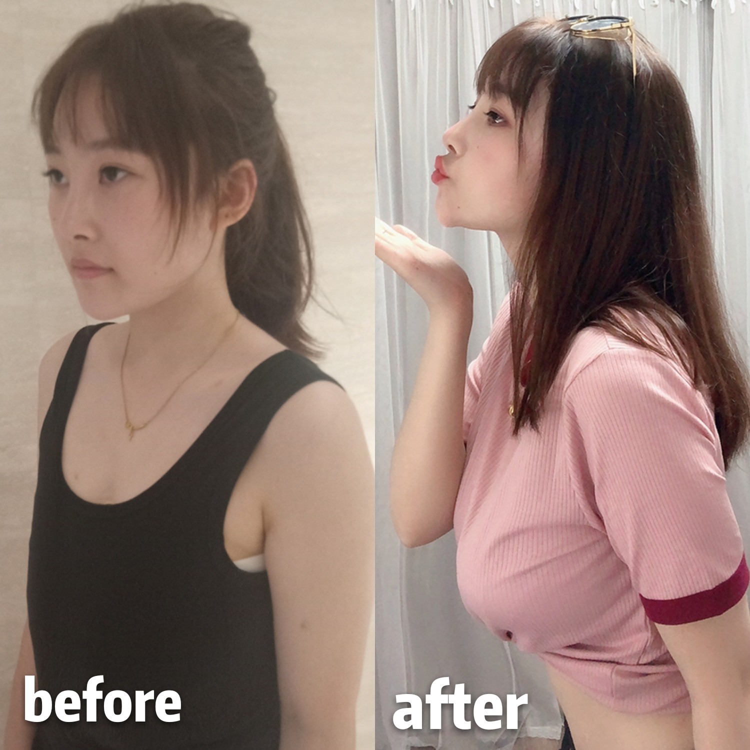 假体隆胸术后会发生移位吗?