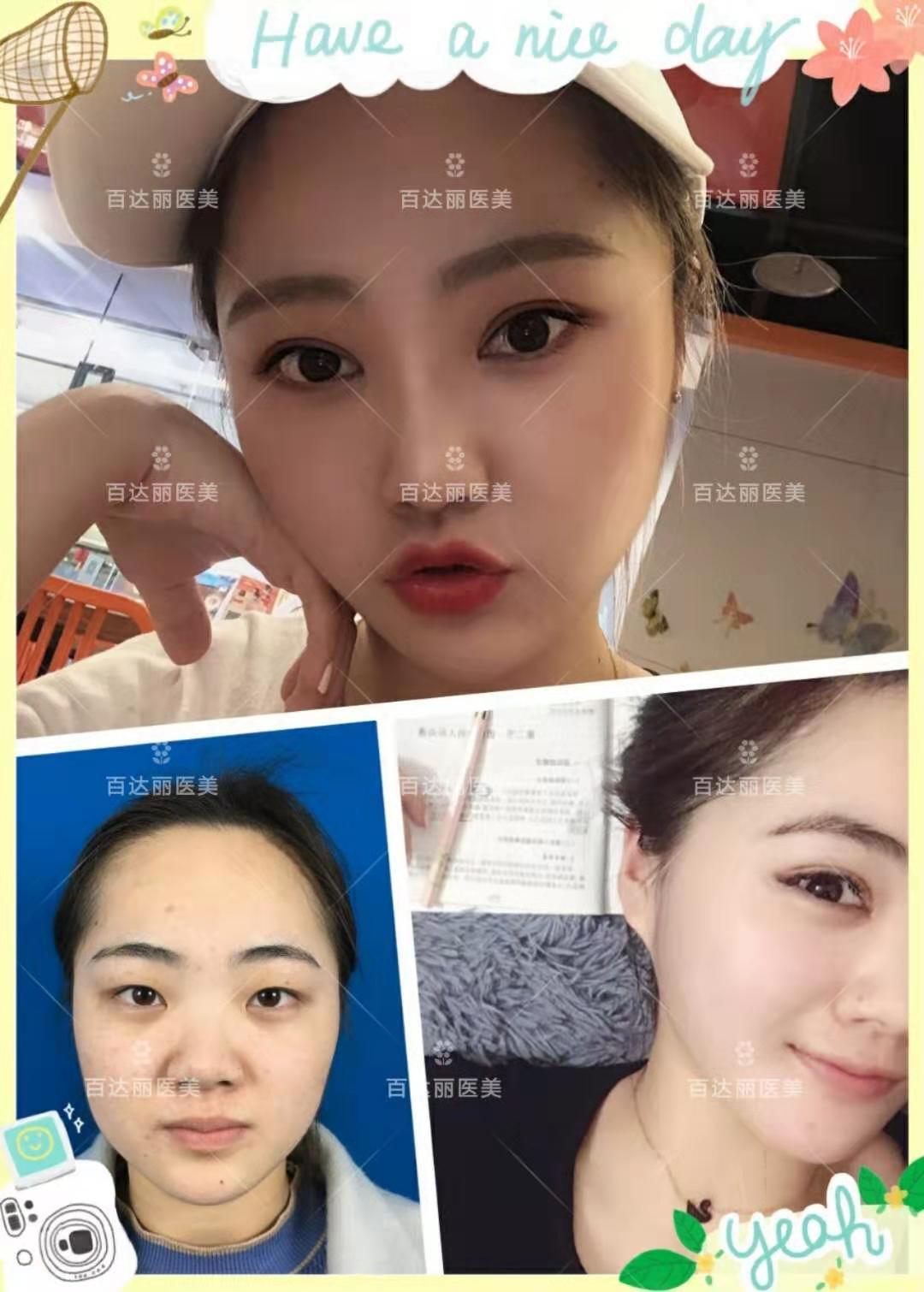 单眼皮小眼睛怎样变大,割双眼皮能让眼_新氧美容整形