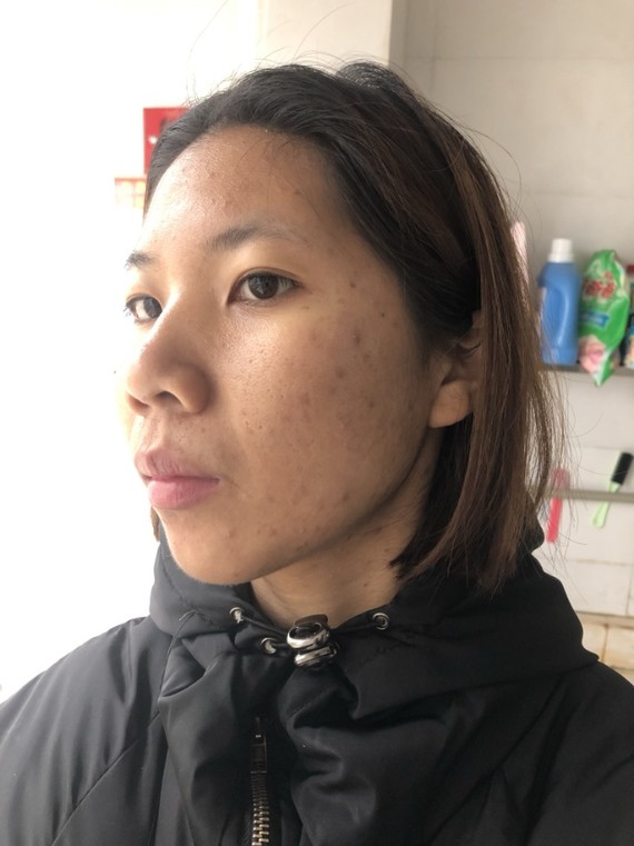 面部,颧弓突出,太阳穴凹陷,高颧骨,法令纹重2.