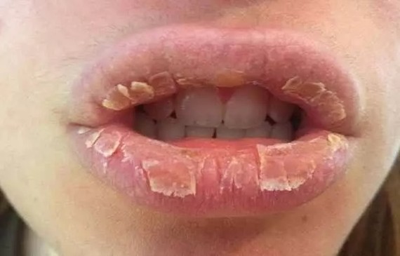 真菌性唇炎症状图片