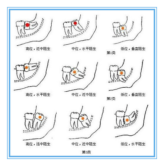 杨幂的脸是拔牙瘦的吗我的脸比较宽下牙有两个横生智齿能不能靠拔牙